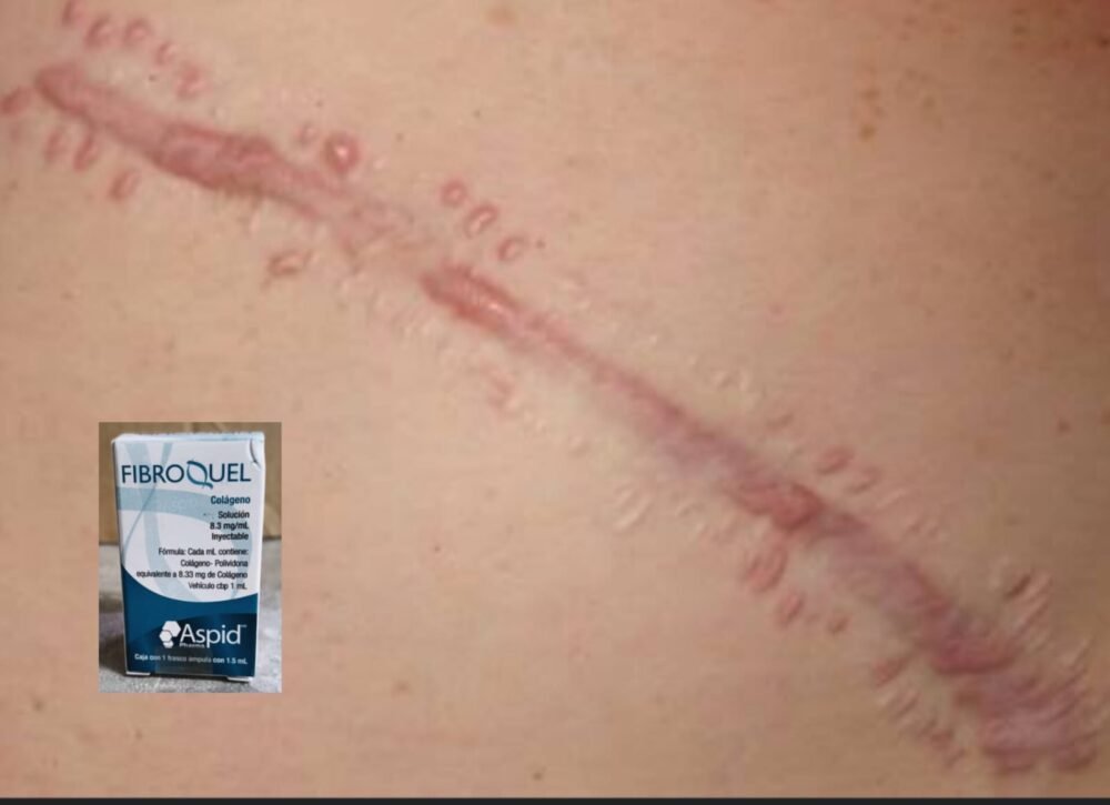 Fibroquel 1.5ml (colágeno) 3 pzs - Image 3